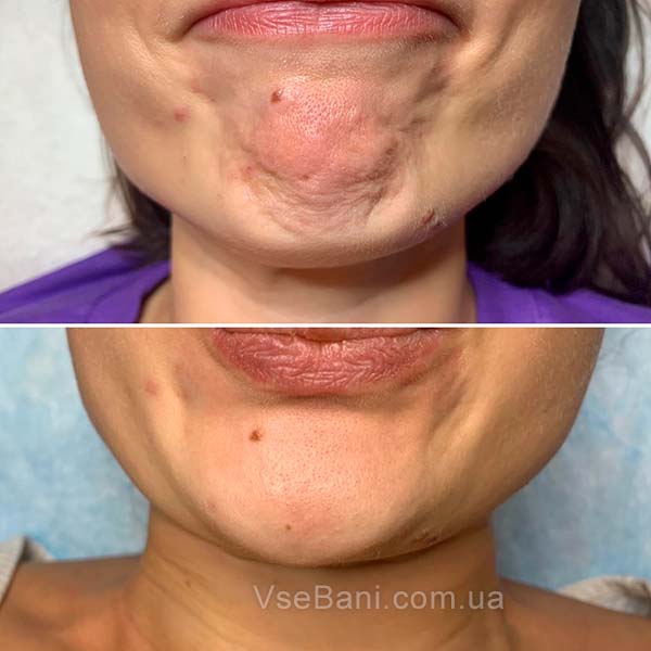 Профилактика появления черных точек на подбородке