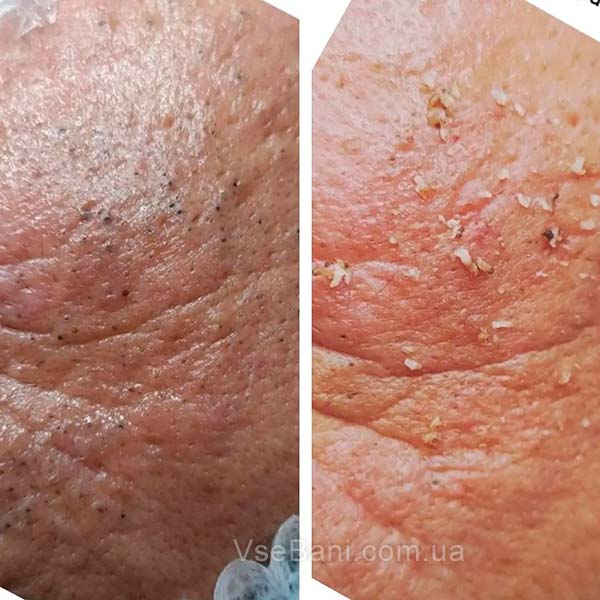 Как убрать черные точки не выдавливая