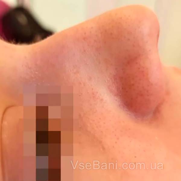 Как убрать чёрные точки на лице. Причины их появления