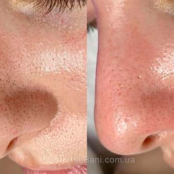 Удаления чёрных точек на лице