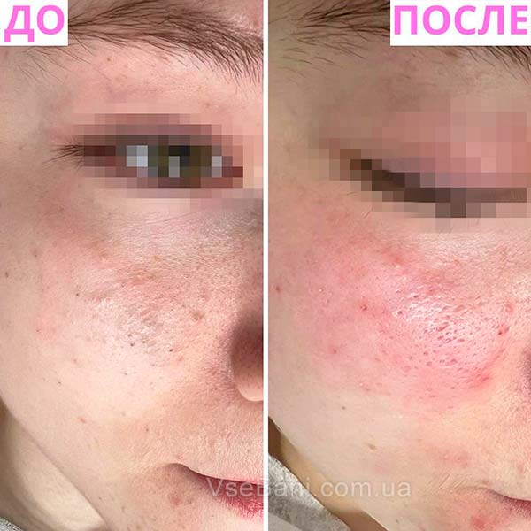 Как убрать чёрные точки на носу у ребёнка Как убрать чёрные точки на носу у ребёнка