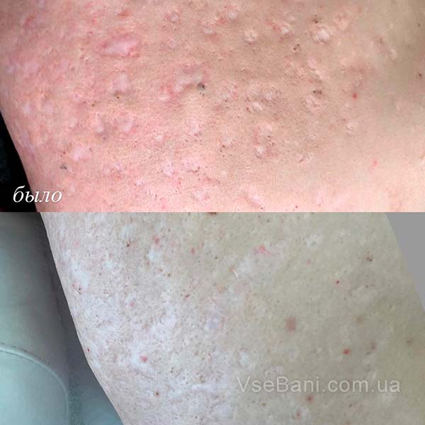 Как убрать рубцы от прыщей