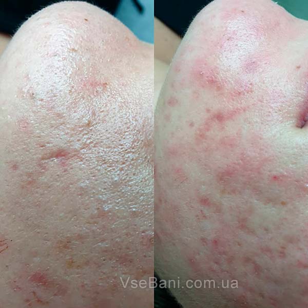 Как убрать шрамы от прыщей Как убрать шрамы от прыщей