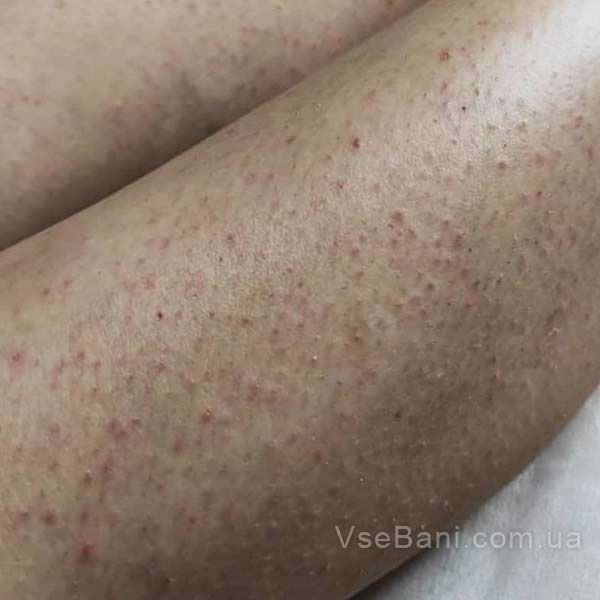 Как убрать следы от прыщей