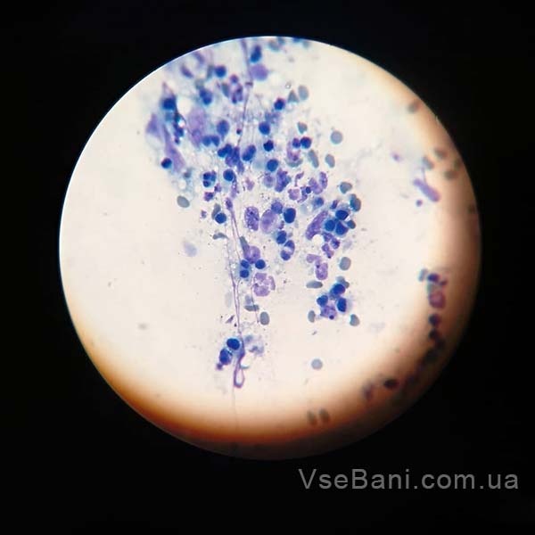 Как убрать следы от прыщей