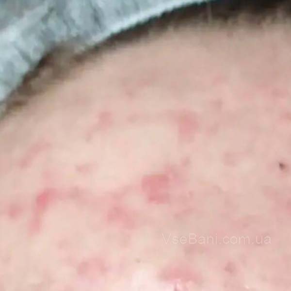 Как убрать сыпь на подбородке у грудничка 