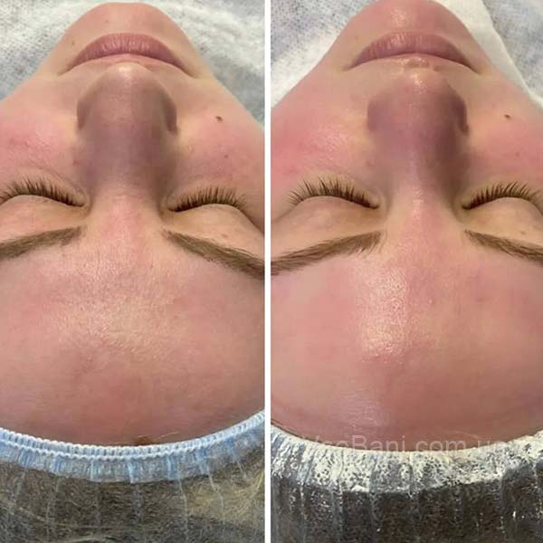 Как убрать сыпь на лбу и подбородке