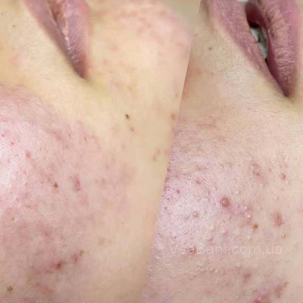 Как убрать красную сыпь на подбородке