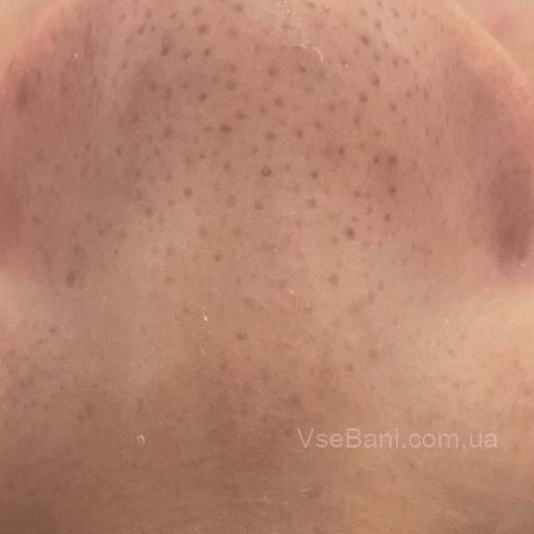 Как убрать постоянную сыпь на подбородке