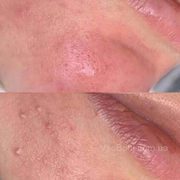 сыпь на подбородке из за ковыряния лица