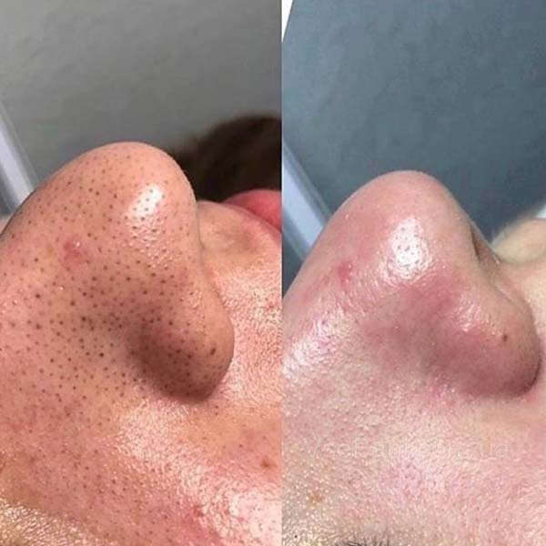 Как убрать угри в домашних условиях 