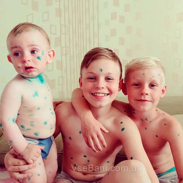 Как убрать угри в ушах у ребенка. Причины. Ветрянка