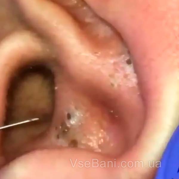 Угри в ушах