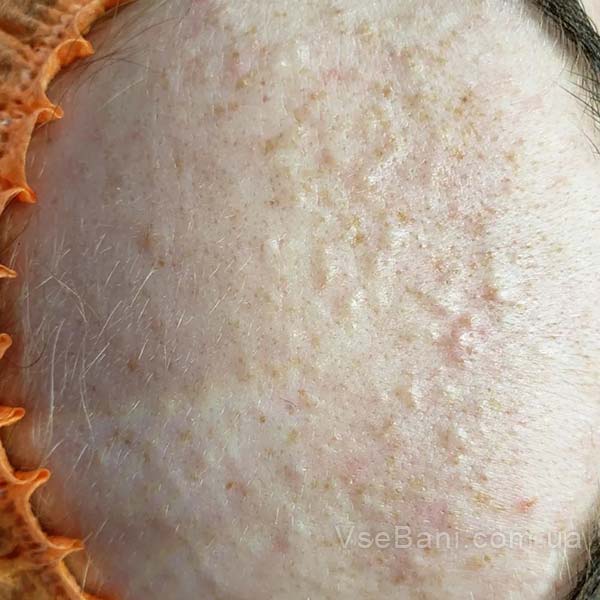 Что делать с прыщем, если времени почти нет Что делать с прыщем, если времени почти нет