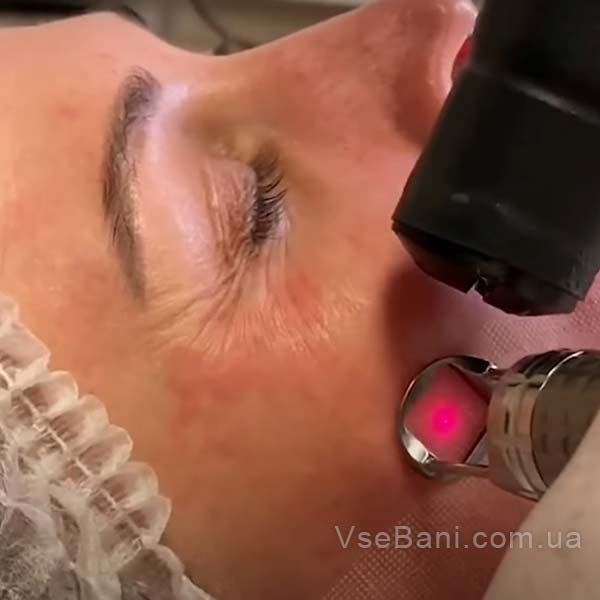 Послепроцедурный уход обязателен из-за значительного покраснения