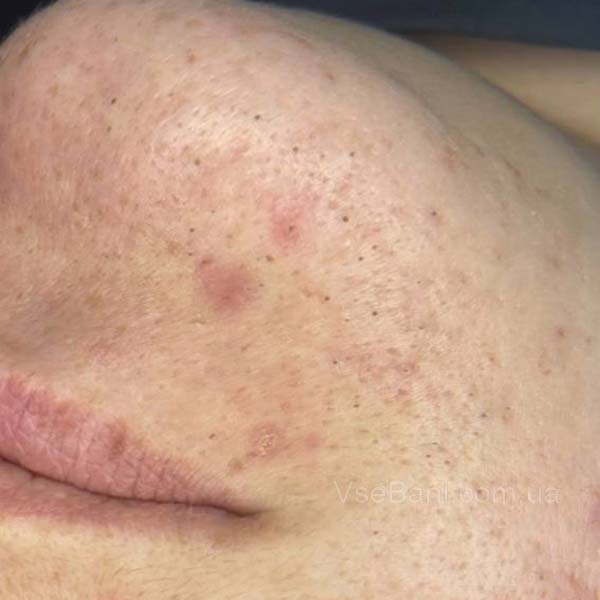 Лечение черных точек Лечение черных точек