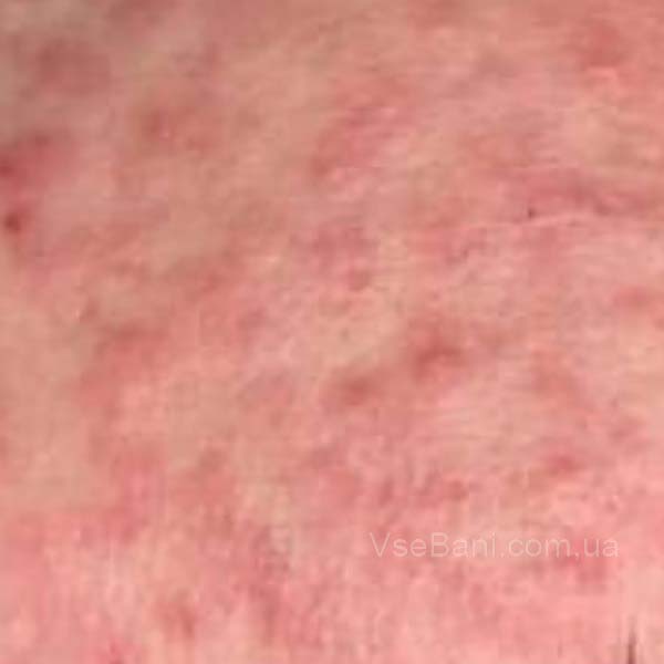 Мелкая сыпь на лбу из за стресса