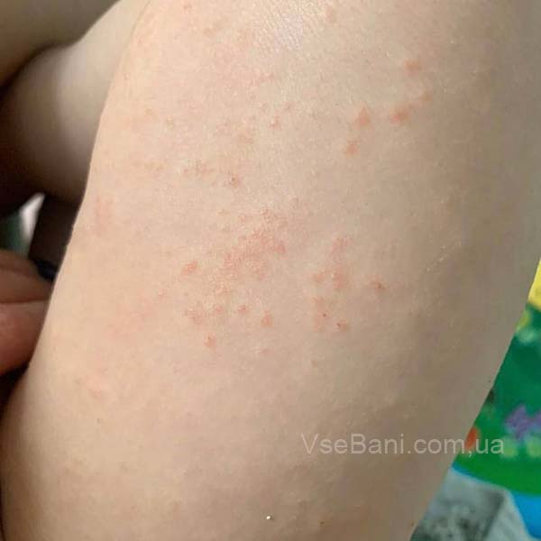 Мелкая сыпь на лице и теле у ребенка Мелкая сыпь на лице и теле у ребенка