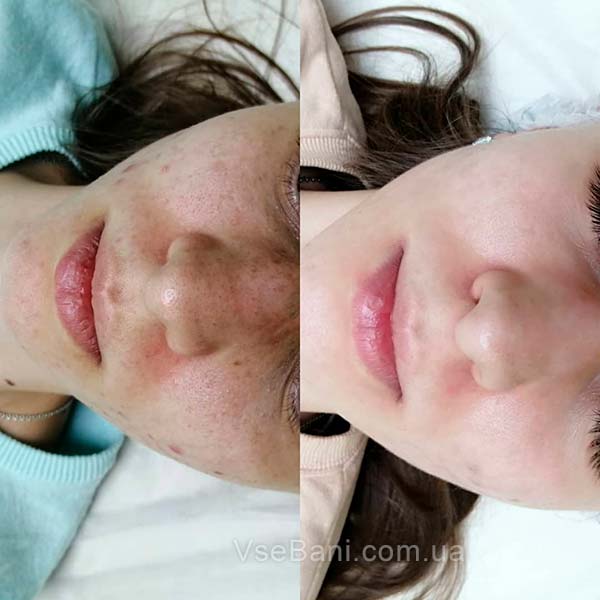 Методы профилактики черных точек Методы профилактики черных точек