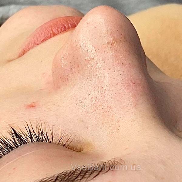 Отчего появляются черные точки Отчего появляются черные точки