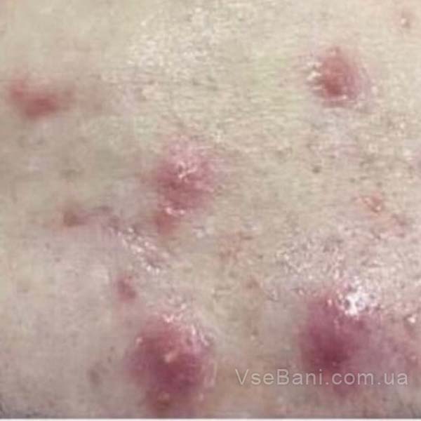 Подкожная сыпь на лице может выглядеть как бугорки