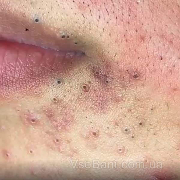 Средства от черных точек в аптеке