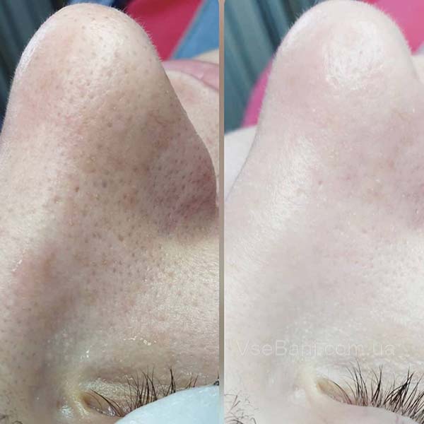 Что такое черные точки Что такое черные точки