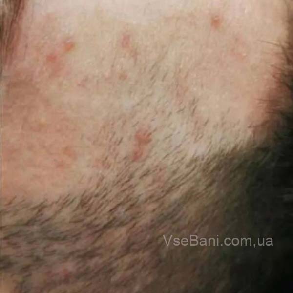 Красная сыпь на голове
