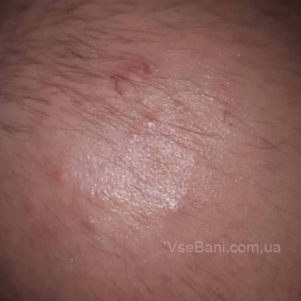 Сыпь на голове зимой