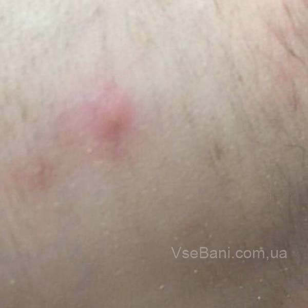 Сыпь на голове у ребенка как избавиться Сыпь на голове у ребенка как избавиться