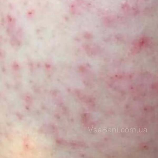 Сыпь на груди и спине у женщин Сыпь на груди и спине у женщин