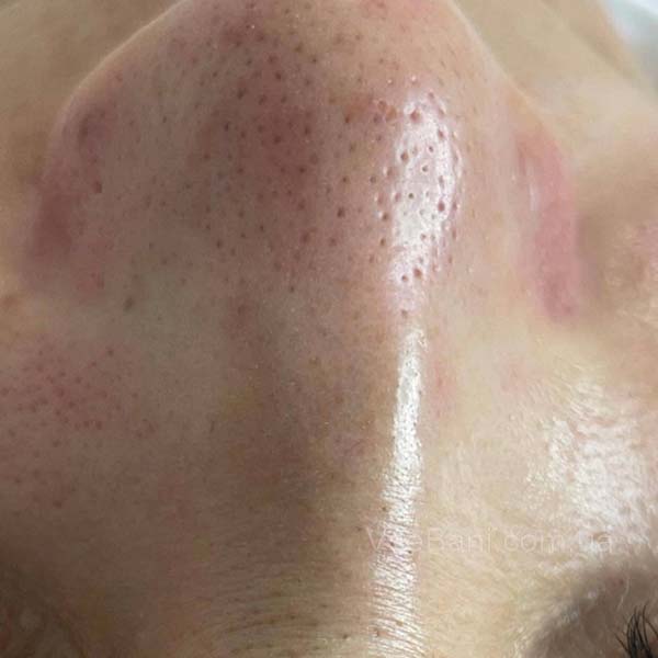 Сыпь на лице: очищение