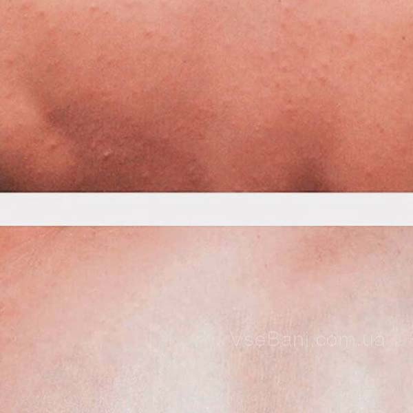 Сыпь на лице от жары