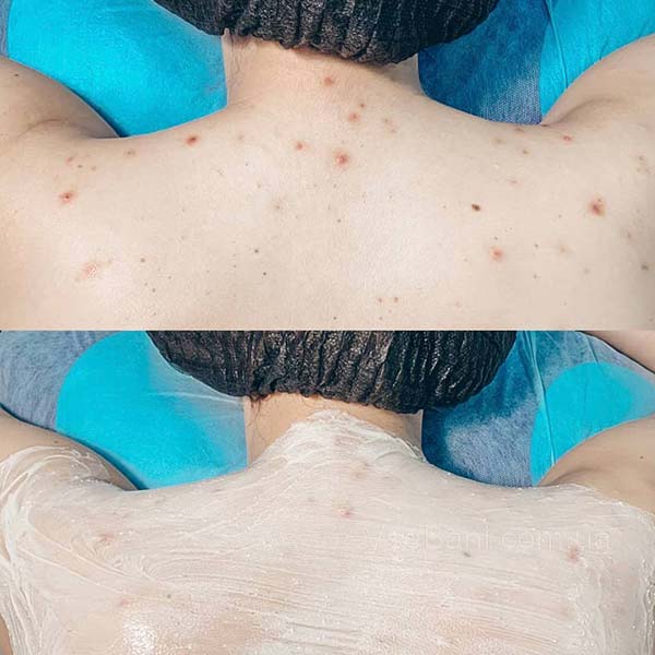 Сыпь на лице и руках : как избавиться