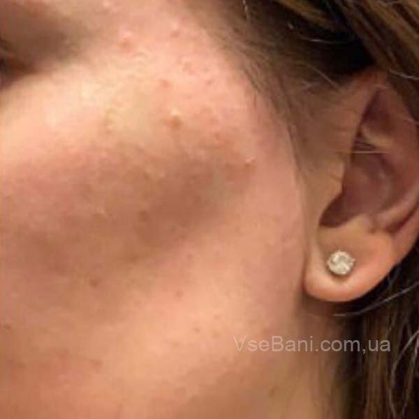 Сыпь на нижней части лица: как избавиться