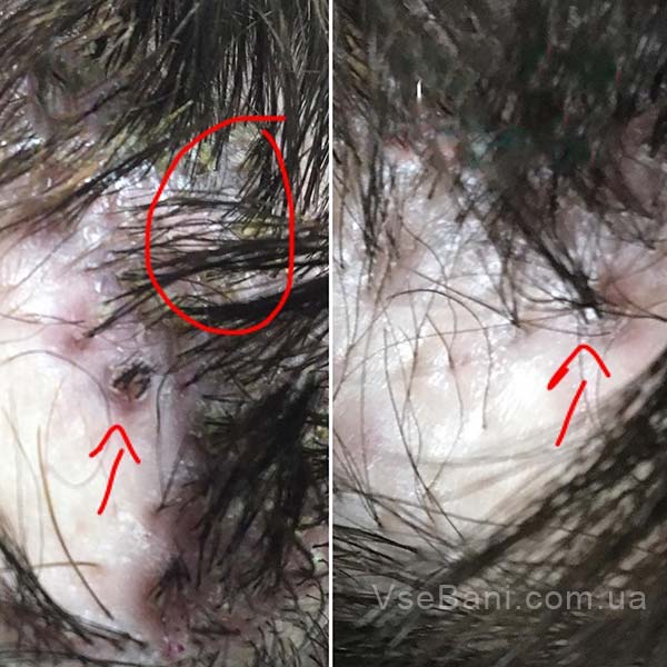 Сыпь на голове у взрослого бывает из-за неправильного ухода Сыпь на голове у взрослого бывает из-за неправильного ухода