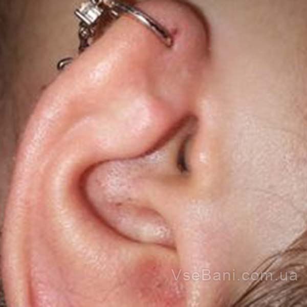 Сыпь на лице и в ушах у взрослого возникает из-за закупорки пор Сыпь на лице и в ушах у взрослого возникает из-за закупорки пор