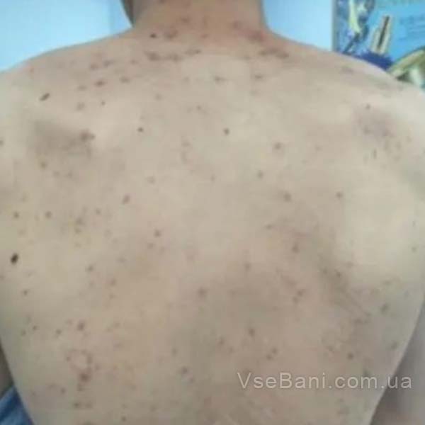 Сыпь на лице, теле, руках и плечах у взрослого - сигнал нарушения работы организма Сыпь на лице, теле, руках и плечах у взрослого - сигнал нарушения работы организма