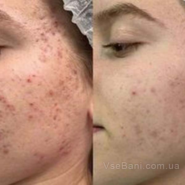 Сыпь на лице у взрослой женщины может быть следствием замедлениея работы организма Сыпь на лице у взрослой женщины может быть следствием замедлениея работы организма