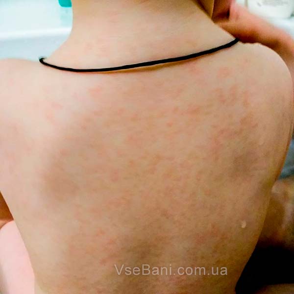 Сыпь на теле ребёнка