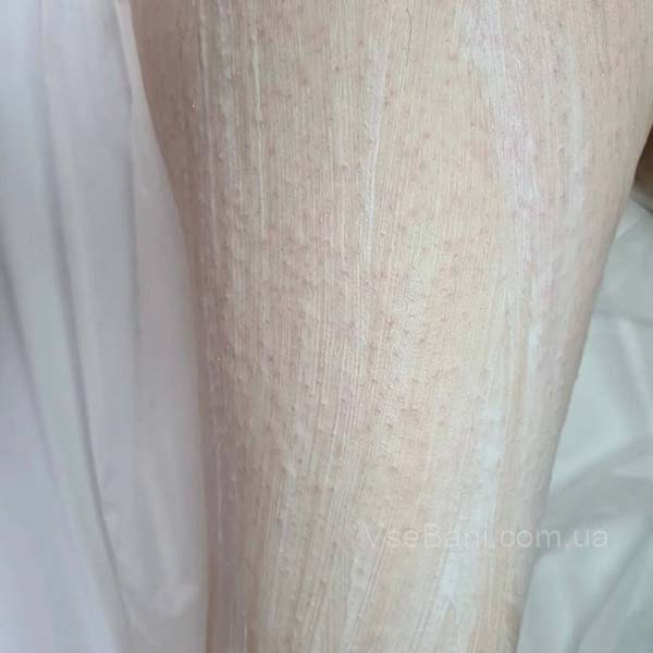 Сыпь на суставах рук и ног