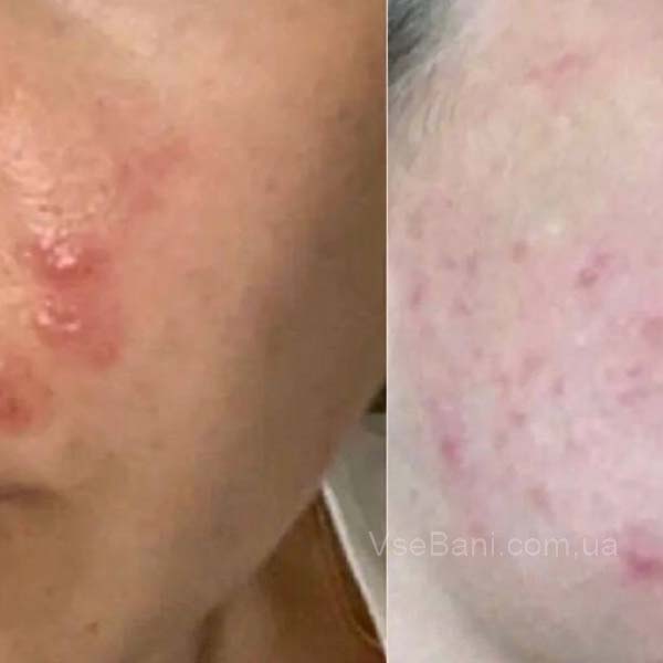 Сыпь на щеках у взрослого