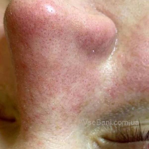 Что вызывает покраснение вокруг носа?