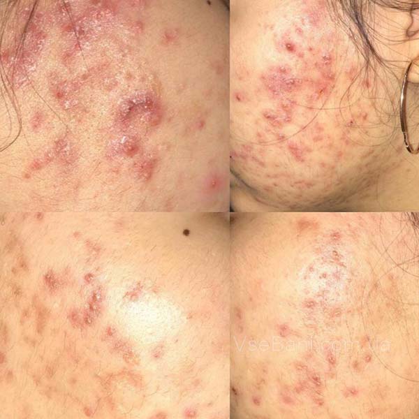 Угри на лице гормональные мази