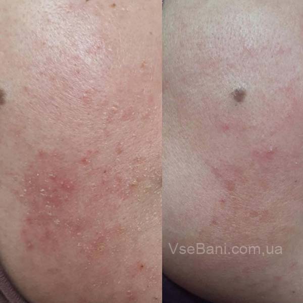 Угри на лице причины