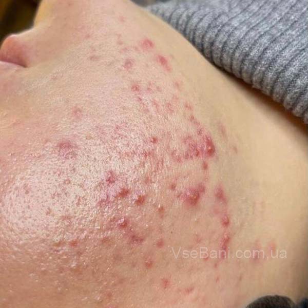 Угри на щеках как избавиться 