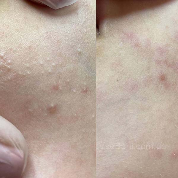 Угри на щеках как избавиться 