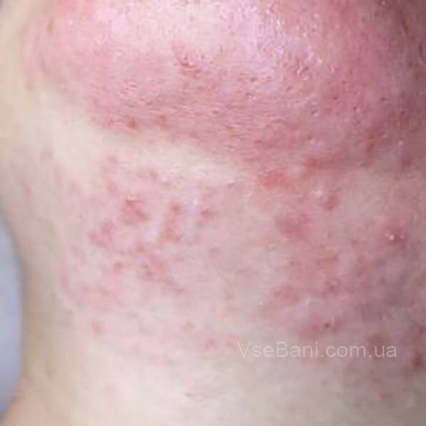 Высыпания на лице по зонам что говорит наука