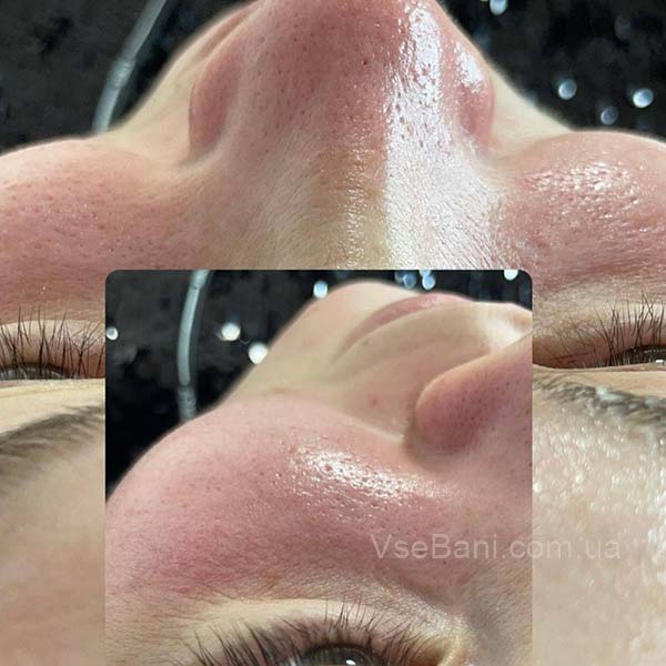 Высыпания на лице по зонам