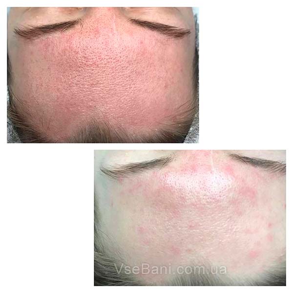 Как избавиться от черных точек на теле